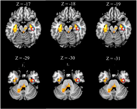 Frontiers Structural And Functional Brain Changes In Patients With