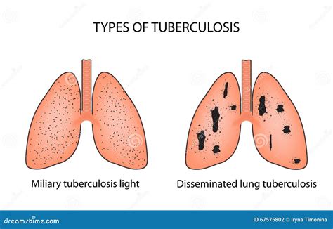 Types Of Tuberculosis Miliary And Disseminated Pulmonary Tuberculosis