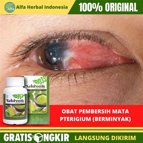 Obat Untuk Penghilang Lamad Lemak Di Mata Pterygium Lemak Dimata Mata