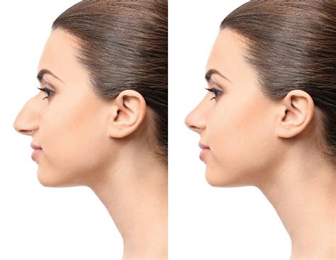 Transform Your Appearance with Rhinoplasty in Chicago Today!