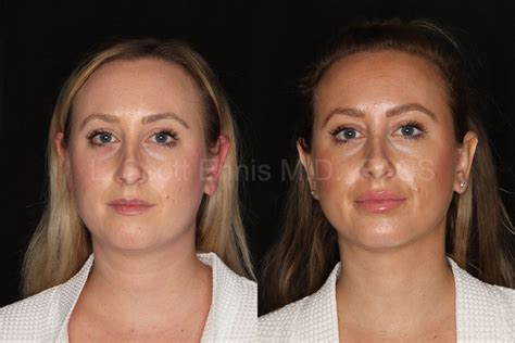 Neck Face Liposuction Before After Photos By Ennis Plastic Surgery