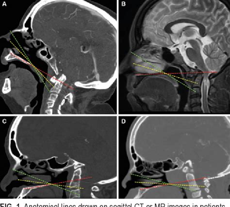 PDF Endoscopic Endonasal Transclival Transodontoid Approach For