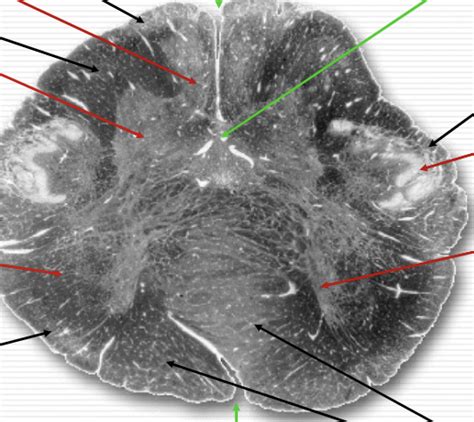 Medulla Pyramidal Decussation Level Diagram Quizlet