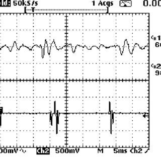 Detected crackles of a lung sound signal sample at the final output ...