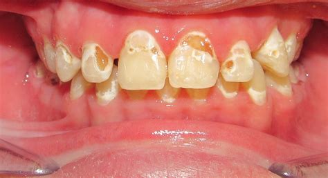 Can You Get Braces With Cavities Connolly Orthodontics In Ballantyne