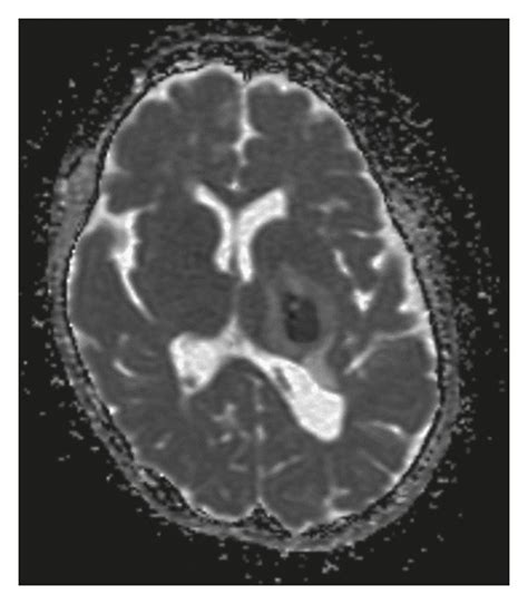 Brain Abscess Detected By Contrast Enhanced Computed Tomography And