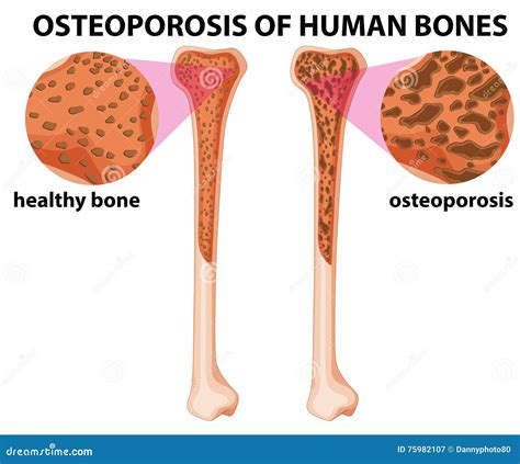 Diagramme Montrant L Ost Oporose Des Os Humains Illustration De Vecteur