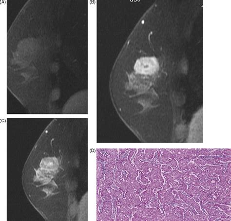 A Wide Variety Of Dynamic Contrast Enhanced Mr Appearances Of Breast