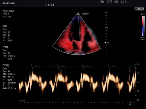 Ultrasound Images Heart Tissue Doppler Echogramm