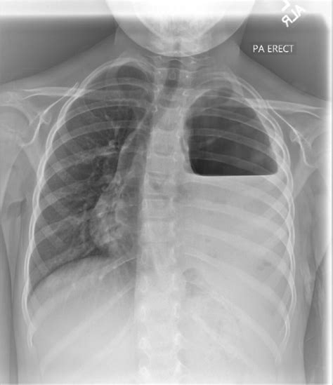 Chest X Ray Hydropneumothorax