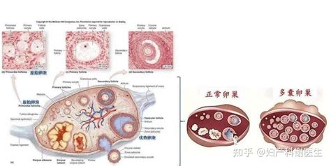 多囊卵巢综合征（pcos）与子宫内膜病变的关系 知乎