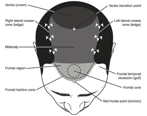 Fms Hair Best Hair Transplant Clinic In Hyderabad India