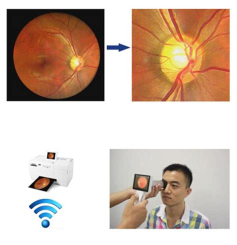 Portable Digital Fundus Camera Non Mydriaticnew Vision Meditec Co Ltd