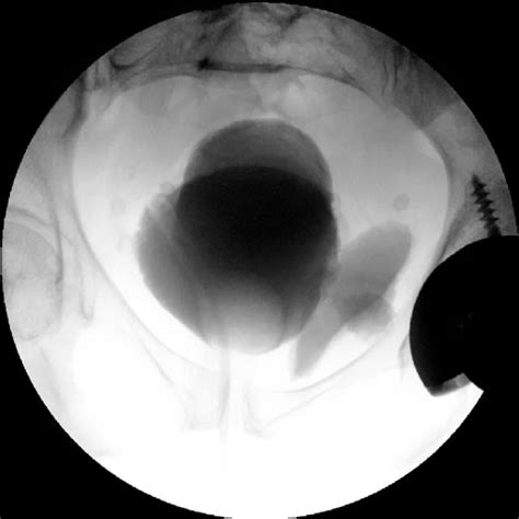 Cystogram performed 2-week status-post left THA showing no evidence of ...