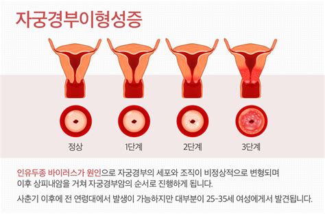 서울자궁경부이형성증 알아두세요 네이버 블로그