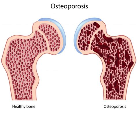 What Is Bone Marrow Edema With Pictures