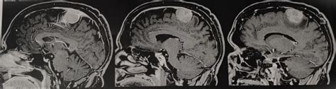 Meningioma o que é e como tratar Dr Luciano Furlanetti