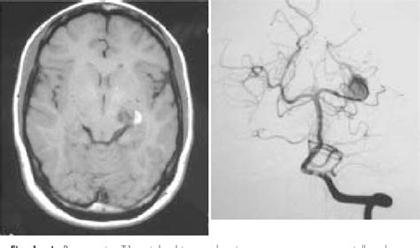 Figure 1 From Surgical Revascularization Of The Posterior Cerebral