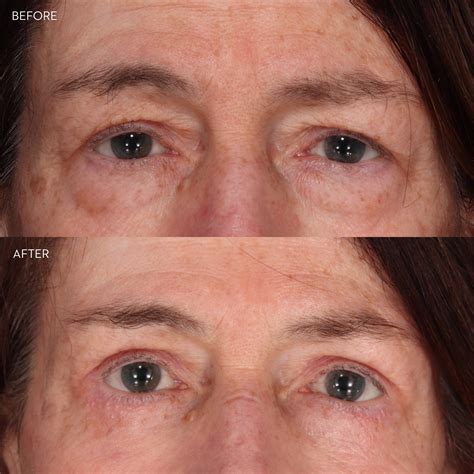 Eyelid Lift Before And After Photos Kirkland Bellevue Marina Park