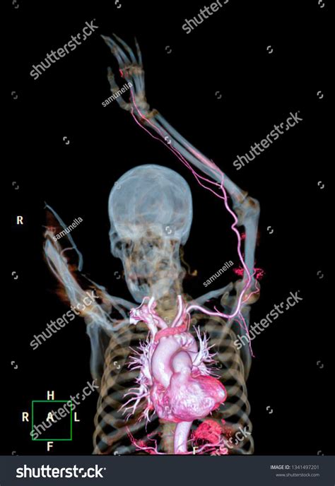 Cta Brachial Artery Ct Scan Upper ภาพประกอบสต็อก 1341497201 Shutterstock