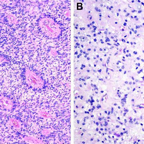 A Cellular Tumor Proliferation Composed Of Cells With Round Nuclei