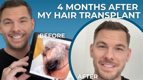 Tyler Parson Months After Multi Unit Hair Grafting Hair