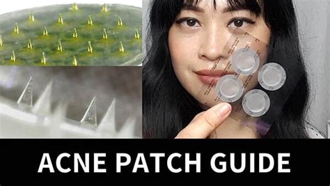 Guide To Acne Patches Hydrocolloid Treatment Microneedle Video Lab Muffin Beauty Science