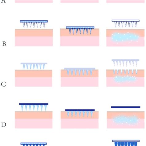 Drug Delivery Mechanisms For Various Types Of Mns A Solid Mns Used