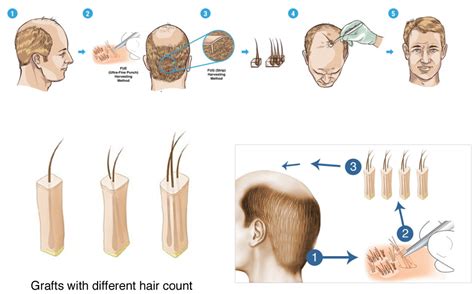 Fue Follicle Unit Excision Hsw Clinic Dr André Nel