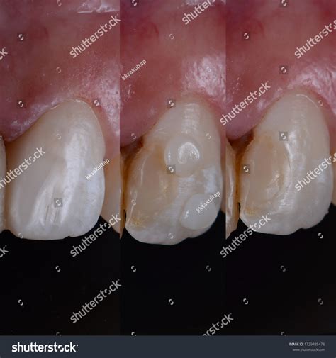 494 Filling Front Teeth Images, Stock Photos & Vectors | Shutterstock