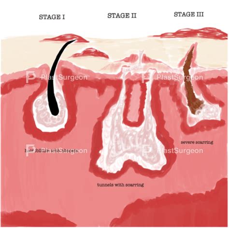 Introduction To Hidradenitis Suppurativa Plastsurgeon