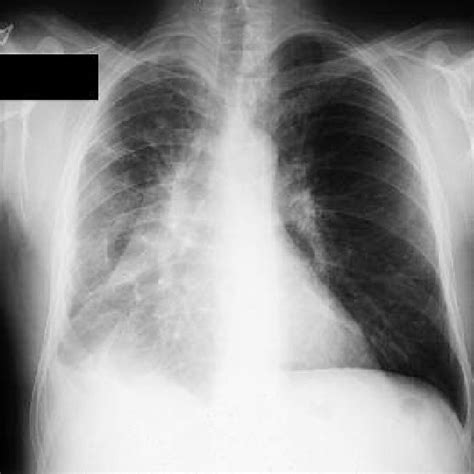 ray image before surgery, depicting a lesion in the right lung ...