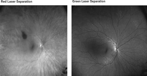 Suspicious Nevus – page 14 of 23 - Retina Revealed