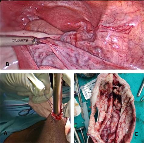 Dermoid Cyst Ovary Removal