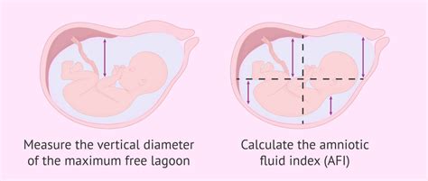 Measurement of amniotic fluid quantity