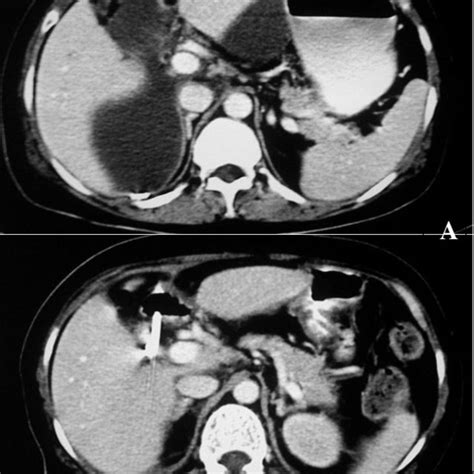 CT Abdomen Showing A Intra Abdominal Collection And B