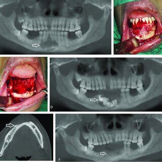 A Panorex Showing Multilocular Glandular Odontogenic Cyst Goc In