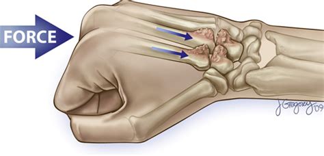 Figure 4 From Disabling Hand Injuries In Boxing Boxers Knuckle And