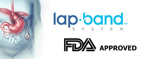 Fda May Ease Lap Band Surgery Guidelines Gregg H Jossart