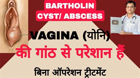 योनि की गांठ का होम्योपैथी इलाज । Bartholin Cyst Cause And Symptoms