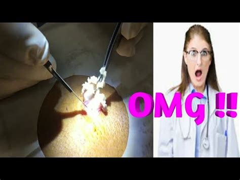 Ingrown Hair Cyst Removal 2019 Cyst Removal Pilonidal Cyst Removal