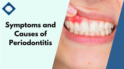 Understanding Periodontitis Symptoms Causes And Treatments