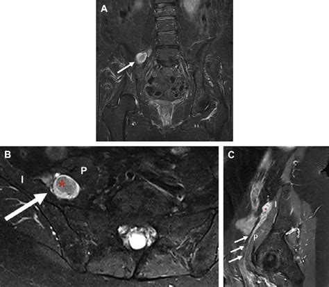 Peripheral Nerve Sheath Tumor Affecting The Lumbosacral Plexus Coronal