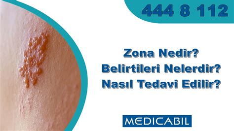 Blog Lenf Bezi Şişmesi Nedir Nedenleri Nelerdir