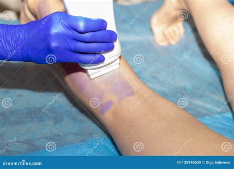 Woman Having Hair Removal Procedure On Leg With Wax Depilatory In Salon