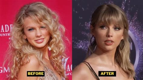 Taylor Swift Plastic Surgery. Her Teeth, Veneers, And Before-After ...