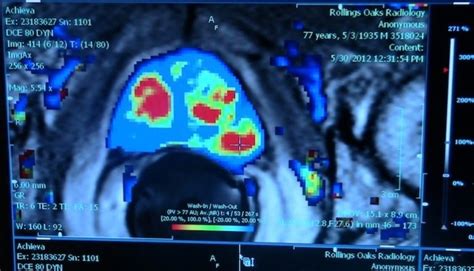 Multiparametric Mri In Prostate Cancer