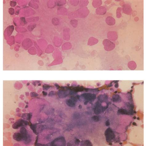 Photomicrograph Of Bone Marrow Aspirate From Case Showing Rosette