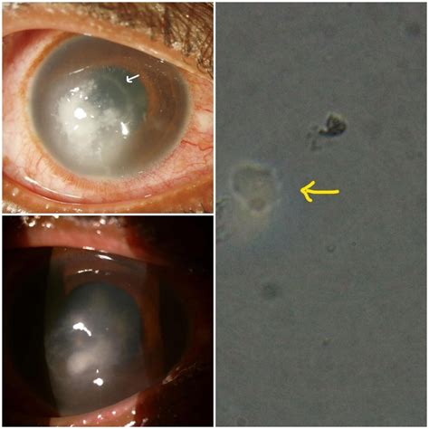 A Clinical Case Series Of Acanthamoeba Keratitis Diagnosed By A Simple Technique Of Detection Of