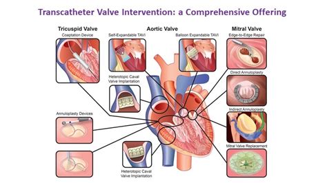 Therapy Of Valvular Heart Diseases A Patient Centred Innovation Journey